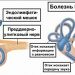 Здоровое ухо и изменения, происходящие при болезни Меньера